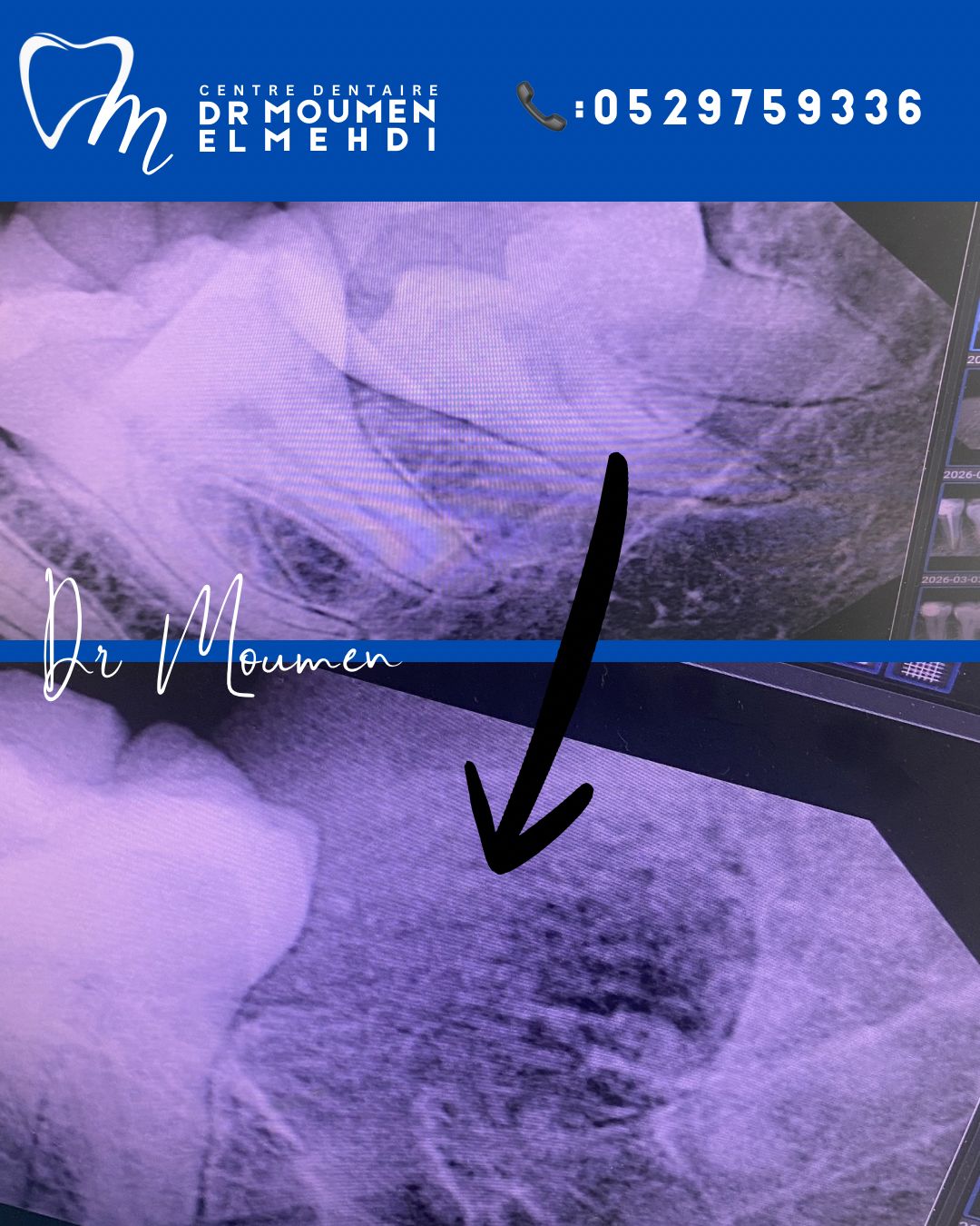 Extraction de dent de sagesse réalisée par le Dr Moumen El Mehdi à Casablanca